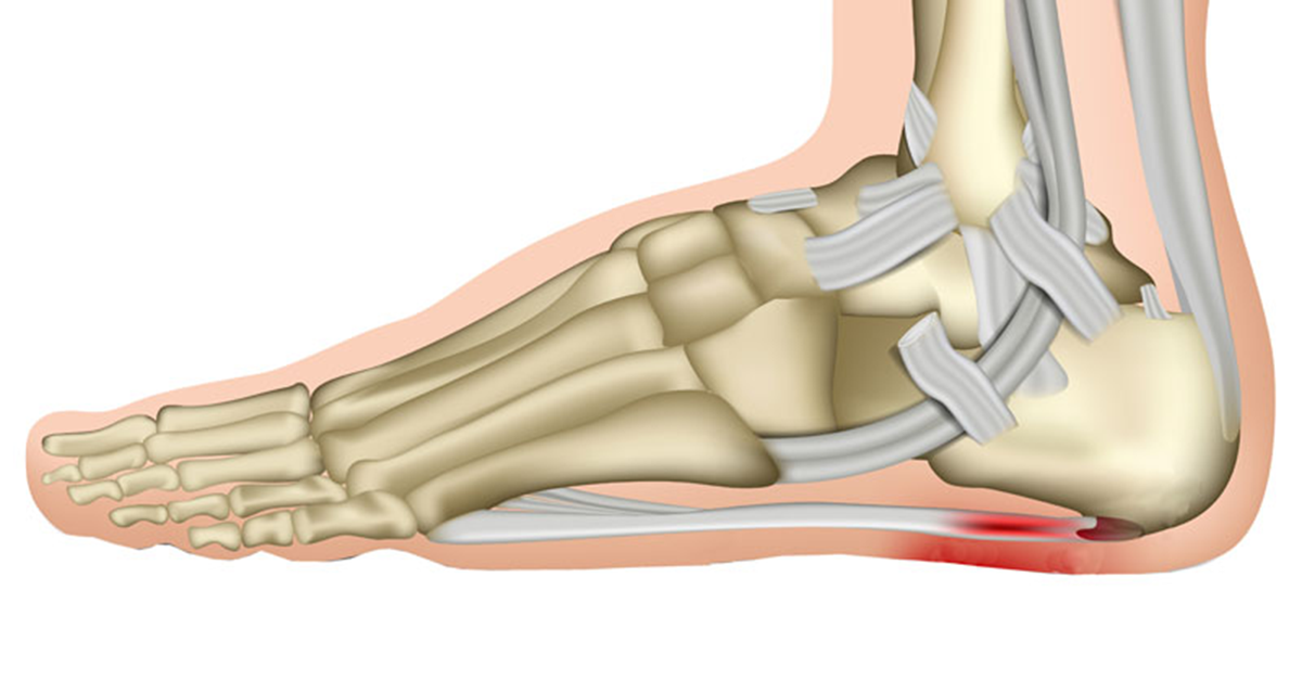 plantar fasciitis