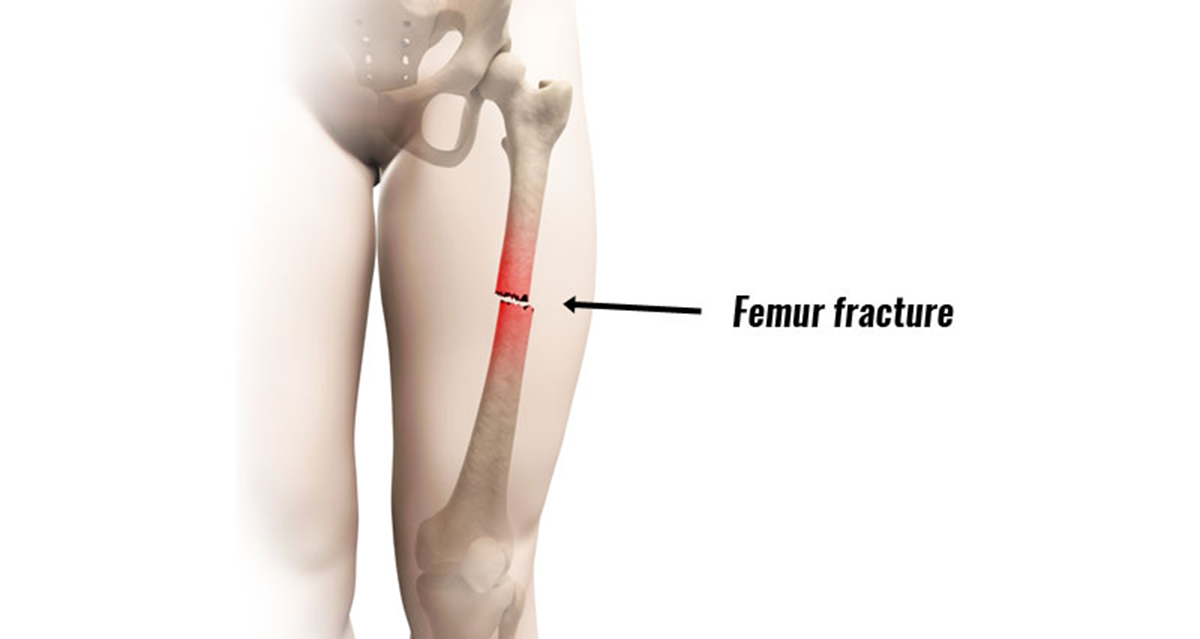 femur fracture