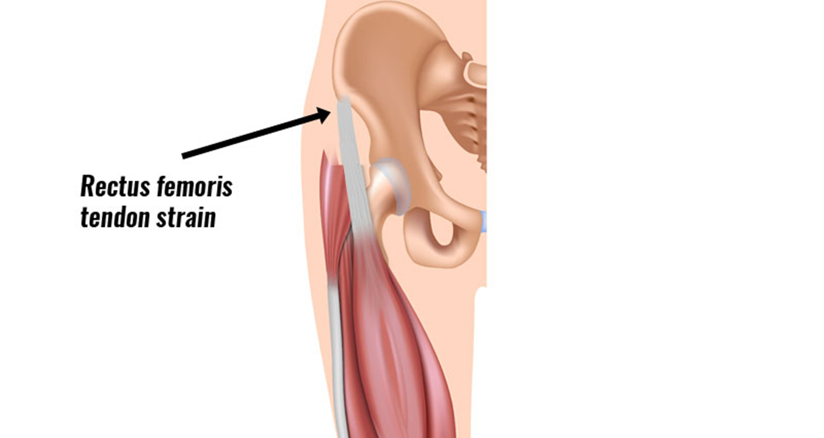 rectus femoris tendon strain