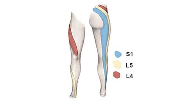 referred hamstring pain