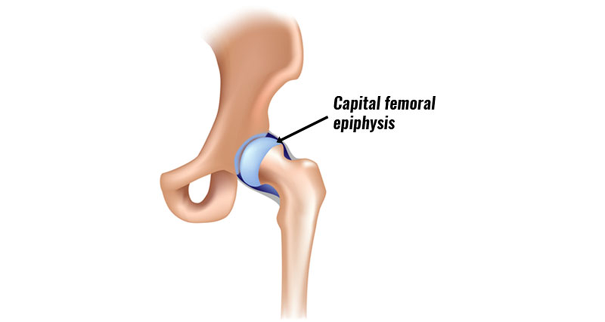 slipped capital femoral epiphysis